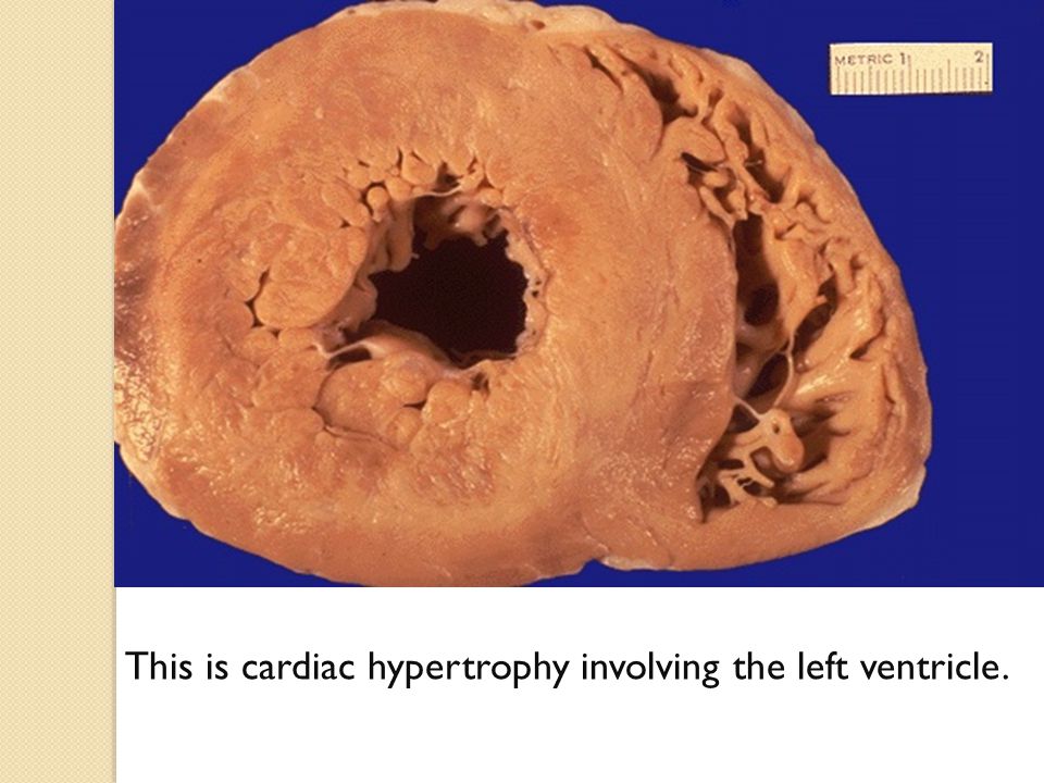 Cetosis hipertrofia